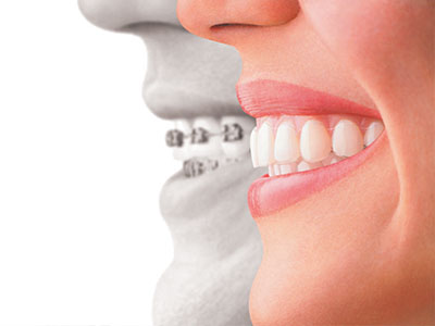 Dental Implants Dentist near Fallbrook