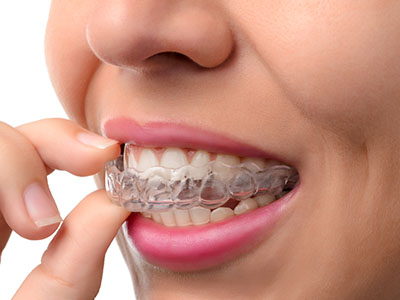Sleep Apnea Dentist Fallbrook