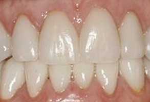 CEREC Dentist Fallbrook