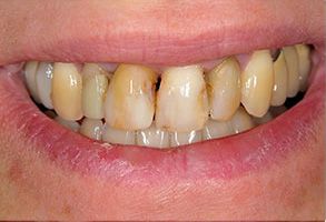 Dental Implants Dentist near Fallbrook